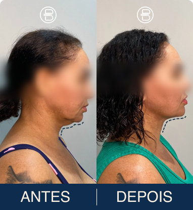 Transformação Caso Clínico 3 - Antes e Depois Lipo de Papada Dr. Bruno Noronha